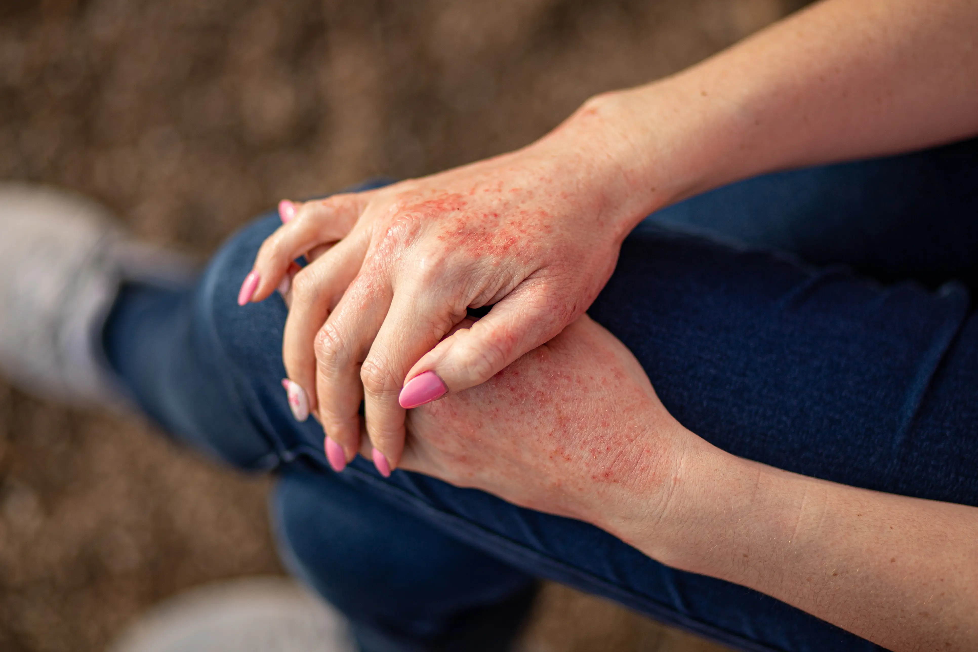 Dermatology